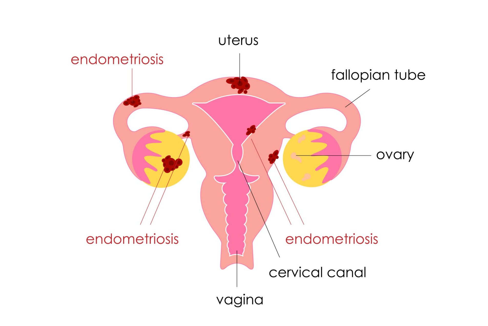 Endometriosis