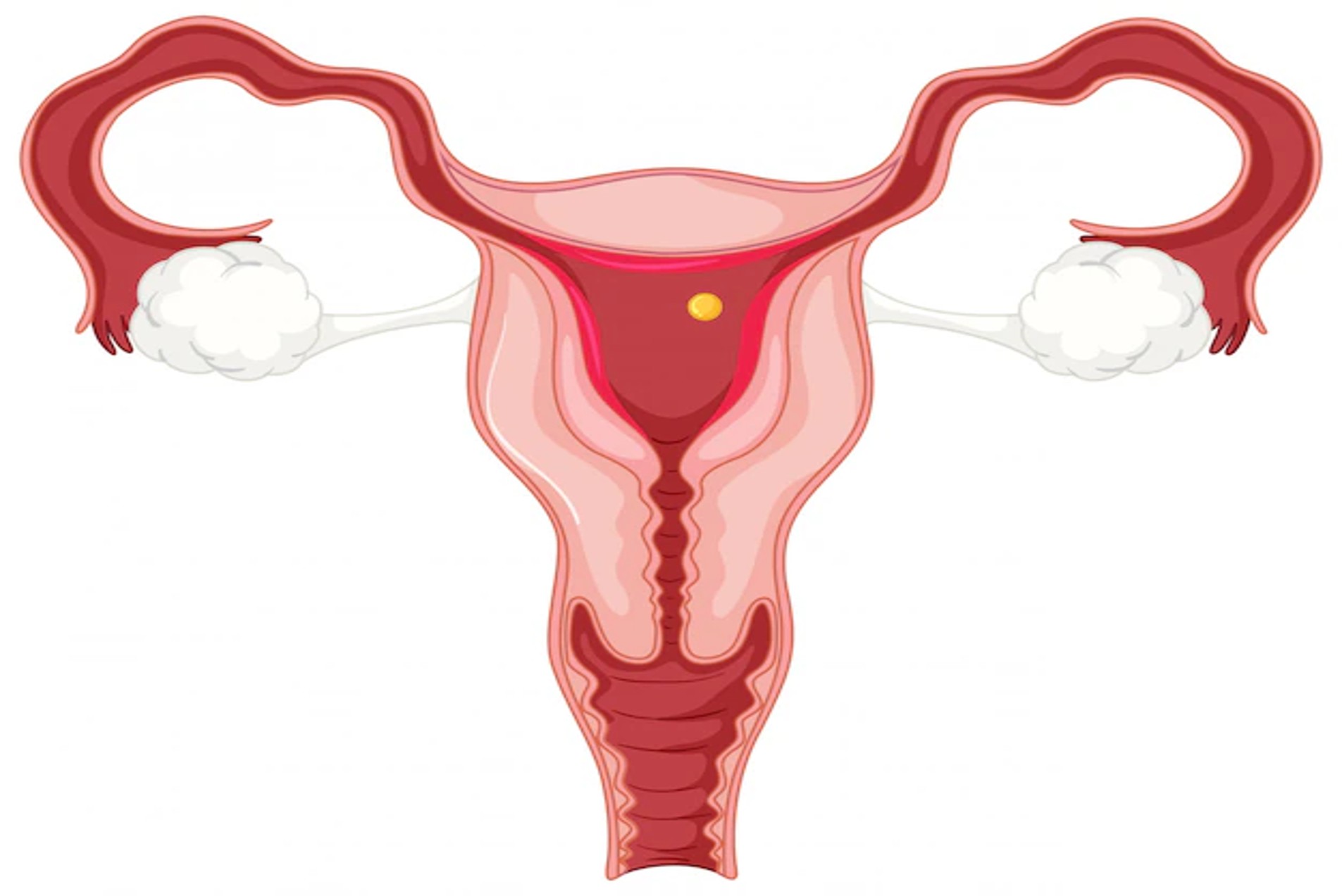 Fibroids jpg