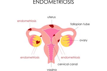 Endometriosis-scaled.jpg